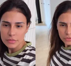 Quanto custou procedimento de Simone Mendes no nariz? Especialista faz ressalva