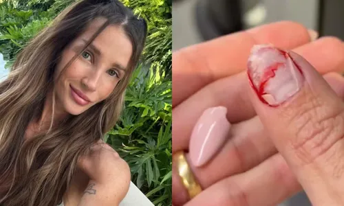 
					Ex-BBB Aline Gotschalg sofre acidente e expõe ferimento na web
				
				