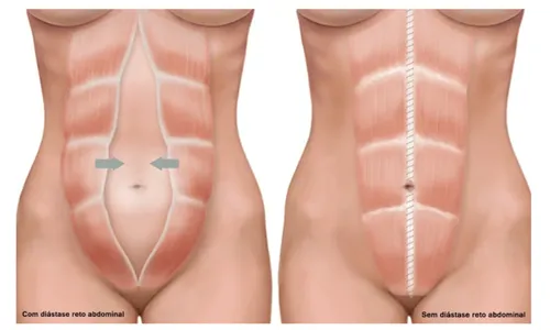 
					Você sabia? Kelly Key costurou musculatura do abdômen após gestação; conheça o segredo da costura abdominal
				
				