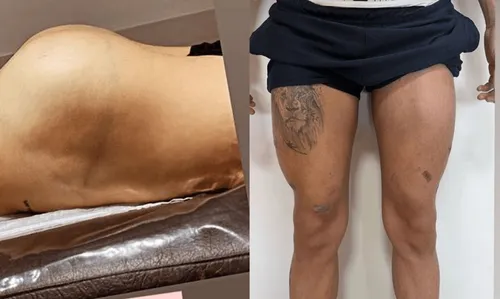 
					Du Cutox à lipo: Rico Melquíades choca com mais de 20 procedimentos estéticos no corpo; veja lista
				
				