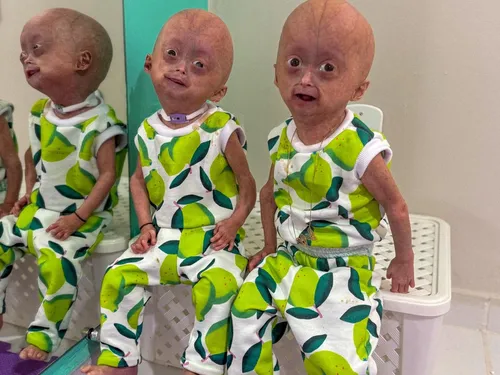 
					Quem era Elis, uma das gêmeas brasileiras diagnosticadas com síndrome rara que morreu aos 5 anos
				
				