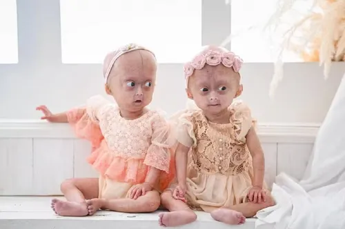 
					Quem era Elis, uma das gêmeas brasileiras diagnosticadas com síndrome rara que morreu aos 5 anos
				
				