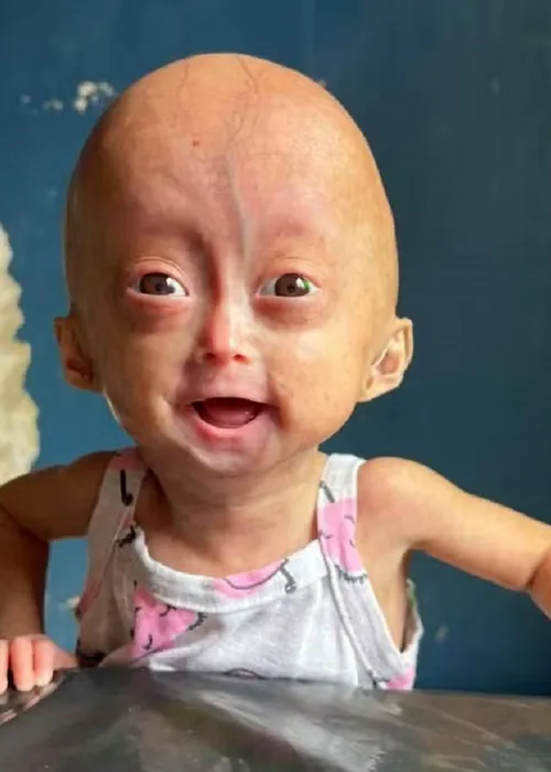 
					Quem era Elis, uma das gêmeas brasileiras diagnosticadas com síndrome rara que morreu aos 5 anos
				
				