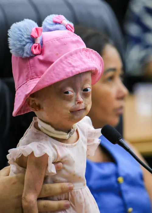 
					Quem era Elis, uma das gêmeas brasileiras diagnosticadas com síndrome rara que morreu aos 5 anos
				
				