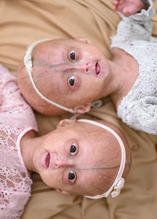 
					Quem era Elis, uma das gêmeas brasileiras diagnosticadas com síndrome rara que morreu aos 5 anos
				
				