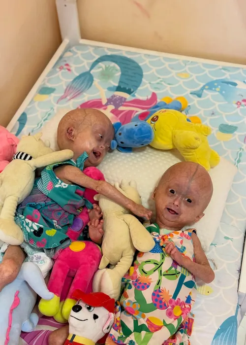 
					Quem era Elis, uma das gêmeas brasileiras diagnosticadas com síndrome rara que morreu aos 5 anos
				
				