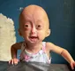 
                  Quem era Elis, uma das gêmeas brasileiras diagnosticadas com síndrome rara que morreu aos 5 anos