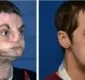 
                  Após transplante facial, homem estampa capa de revista famosa