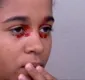 
                  Adolescente sofre com sangramentos pelos olhos no sul da Bahia