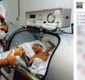 
                  Gêmeo siamês que sobreviveu a cirurgia sai de UTI para clínica