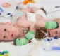 
                  Gêmeos siameses são separados após 12 horas de cirurgia