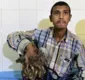 
                  Com doença rara, homem fica conhecido como "homem-árvore"