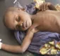 
                  Mais de 58 mil crianças podem morrer de fome na Somália