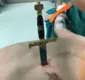 
                  Médicos retiram espada cravada no peito de paciente