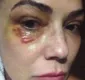 
                  Luiza Brunet divulga foto do rosto após agressão do ex namorado