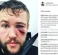 
                  Depois de derrota, lutador mostra rosto machucado e fratura