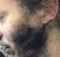 
                  Australiana sofre queimaduras após explosão de fones de ouvido