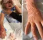 
                  Tatuagem de henna gera cicatrizes permanentes em menina de 7 anos