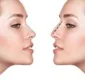 
                  Mulher fica com rosto desfigurado após plástica no nariz