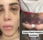 
                  Youtuber Camilla Uckers fica sem andar após infecção no glúteo
