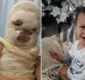 
                  Bebê fica com rosto desfigurado após  acidente com cafeteira