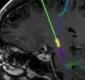
                  Estimulação cerebral profunda freia tremores do mal de Parkinson