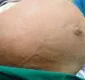 
                  Mioma uterino de 64 centímetros e 28 kg é removido de paciente
