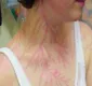 
                  Imagens revelam marcas na pele de quem foi atingido por raio