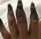 
                  Mulher tem necrose em oito dedos após fazer faxina