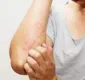 
                  Dermatite atópica não tem cura, mas pode ser controlada em casa