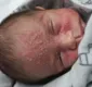 
                  Bebê contrai herpes com 17 dias de idade e mãe faz alerta