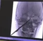 
                  Adolescente sobrevive ao tirar faca cravada no crânio após queda