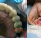 
                  Adolescente suspeita de tumor em testículo e encontra dente molar