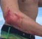 
                  Surfista é mordido por tubarão, mas troca hospital por bar