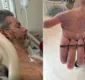 
                  Homem fica com prego de 7,5cm cravado no coração após acidente