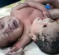 
                  Bebê nasce com duas cabeças e três braços