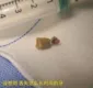 
                  Paciente descobre dente que cresceu no nariz
