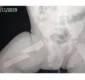 
                  Homem é preso por tortura após fraturar o fêmur de filho de meses