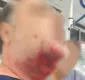 
                  Paciente surta e arranca pedaço de rosto de médico com mordida