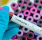
                  Bahia registra 176 casos confirmados de coronavírus