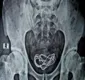 
                  Homem enfia cabo de carregador de celular no próprio pênis