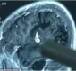 
                  Homem faz cirurgia para retirar verme vivo do cérebro