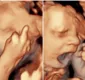 
                  Bebê é flagrado mostrando dedo médio e bocejando em ultrassom