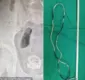 
                  Garoto passa por cirurgia às pressas após enfiar fio no pênis