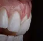 
                  Saiba tudo sobre as lentes de contatos dentárias
