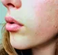 
                  Quatro dicas para disfarças os poros com a maquiagem