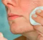 
                  Descubra como minimizar poros dilatados