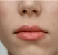 
                  Pump lips: conheça procedimento estético para lábios volumosos