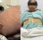 
                  Mulher passa a pesar 49 quilos após ter tumor de 47 removido