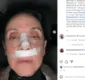 
                  Cininha de Paula fratura o rosto em acidente: 'Me recuperando'